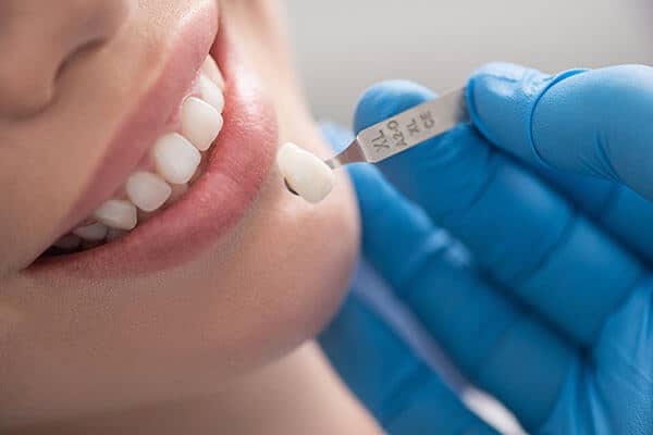 Coroas e facetas dentárias, estética dentária, tratamento estético nos dentes