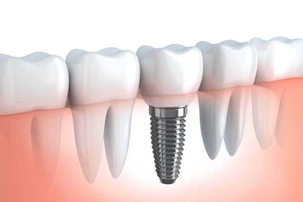 implantes dentários, dentes fixos no mesmo dia, tratamento implantologia